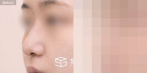 슈가성형외과 첫) 콧대 + 귀연골 + 기증늑 + 메부리 + 복코교정 전후사진 - 정면 수술 전후 비교