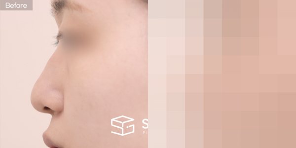 슈가성형외과 첫) 콧대 + 귀연골 + 기증늑 + 메부리 + 복코교정 전후사진 - 45도 수술 전후 비교