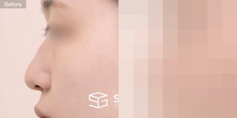 슈가성형외과 첫) 콧대 + 귀연골 + 기증늑 + 메부리 + 복코교정 전후사진 - 45도 수술 전후 비교