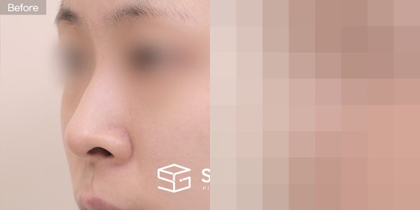 슈가성형외과 첫) 콧대 + 기증늑 + 비중격 + 메부리 + 비공내리기 + 콧볼축소 전후사진 - 정면 수술 전후 비교
