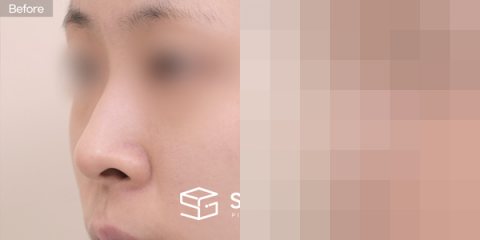 슈가성형외과 첫) 콧대 + 기증늑 + 비중격 + 메부리 + 비공내리기 + 콧볼축소 전후사진 - 정면 수술 전후 비교