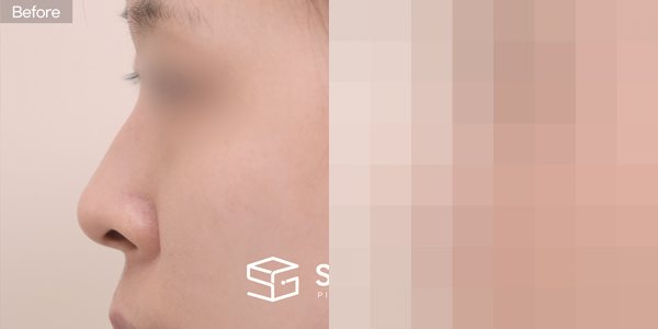 슈가성형외과 첫) 콧대 + 기증늑 + 비중격 + 메부리 + 비공내리기 + 콧볼축소 전후사진 - 45도 수술 전후 비교
