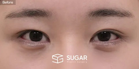 슈가성형외과 첫) 비절개눈매교정 + 윗트임 + 웨이브뒤밑트임 전후사진 - 수술 전