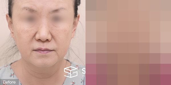 슈가성형외과 첫) 안면거상 + 자연유착 + 하안검 + 눈썹거상 전후사진 - 정면 수술 전후 비교