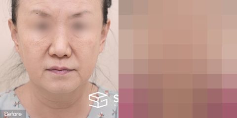 슈가성형외과 첫) 안면거상 + 자연유착 + 하안검 + 눈썹거상 전후사진 - 정면 수술 전후 비교