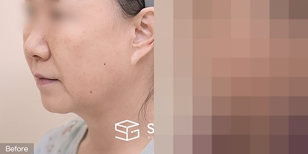 슈가성형외과 첫) 안면거상 + 자연유착 + 하안검 + 눈썹거상 전후사진 - 45도 수술 전후 비교