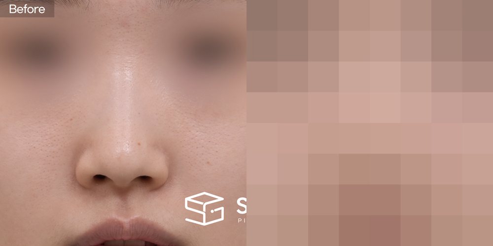 슈가성형외과 첫) 기증늑 + 귀연골 + 콧대 + 절골 + 복코 전후사진 - 정면 수술 전후 비교