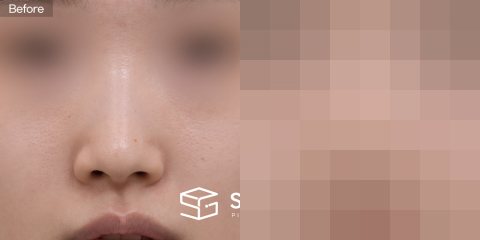 슈가성형외과 첫) 기증늑 + 귀연골 + 콧대 + 절골 + 복코 전후사진 - 정면 수술 전후 비교