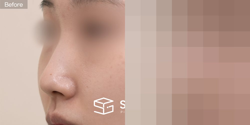 슈가성형외과 첫) 기증늑 + 귀연골 + 콧대 + 절골 + 복코 전후사진 - 45도 수술 전후 비교