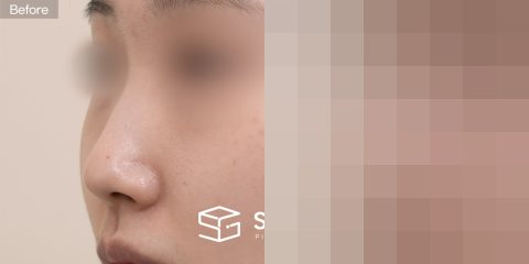 슈가성형외과 첫) 기증늑 + 귀연골 + 콧대 + 절골 + 복코 전후사진 - 45도 수술 전후 비교