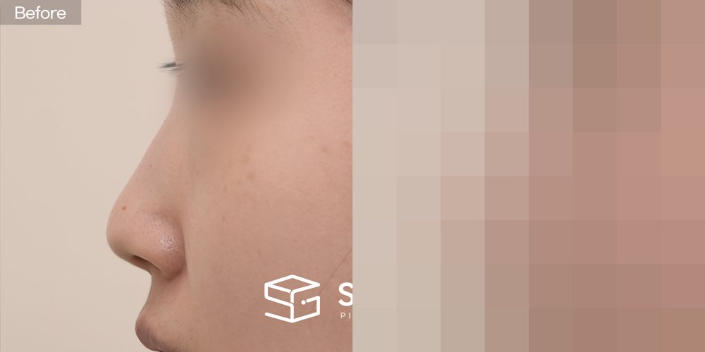 슈가성형외과 첫) 기증늑 + 귀연골 + 콧대 + 절골 + 복코 전후사진 - 측면 수술 전후 비교