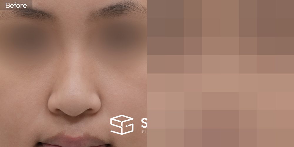 슈가성형외과 첫) 콧대 + 귀뒤근막 + 코끝 + 비중격 + 귀연골 + 복코 + 긴코 전후사진 - 정면 수술 전후 비교