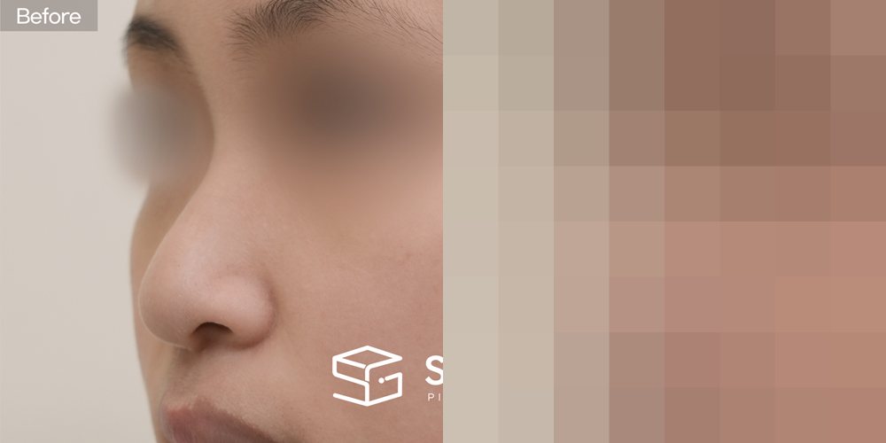 슈가성형외과 첫) 콧대 + 귀뒤근막 + 코끝 + 비중격 + 귀연골 + 복코 + 긴코 전후사진 - 45도 수술 전후 비교