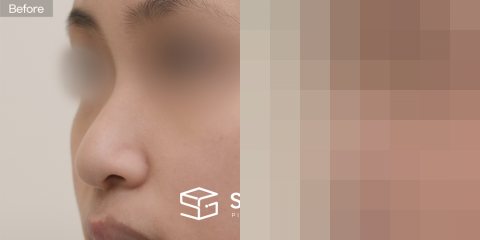 슈가성형외과 첫) 콧대 + 귀뒤근막 + 코끝 + 비중격 + 귀연골 + 복코 + 긴코 전후사진 - 45도 수술 전후 비교