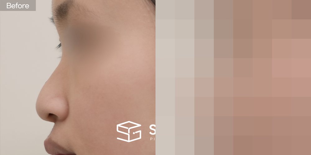 슈가성형외과 첫) 콧대 + 귀뒤근막 + 코끝 + 비중격 + 귀연골 + 복코 + 긴코 전후사진 - 측면 수술 전후 비교