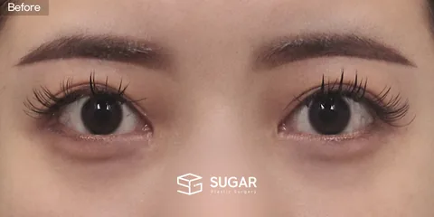 슈가성형외과 재) 절개 전후사진 - 수술 전