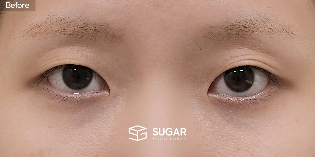 슈가성형외과 첫) 비절개눈매교정 + 앞트임 전후사진 - 수술 전