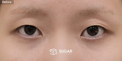 슈가성형외과 첫) 비절개눈매교정 + 앞트임 전후사진 - 수술 전