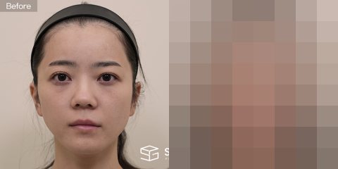 슈가성형외과 첫) 눈 밑 지방 재배치 + 이마거상 + 무보형물 + 자가늑 + 콧볼축소 + 복코 + 비주 연장 전후사진 - 정면 수술 전후 비교