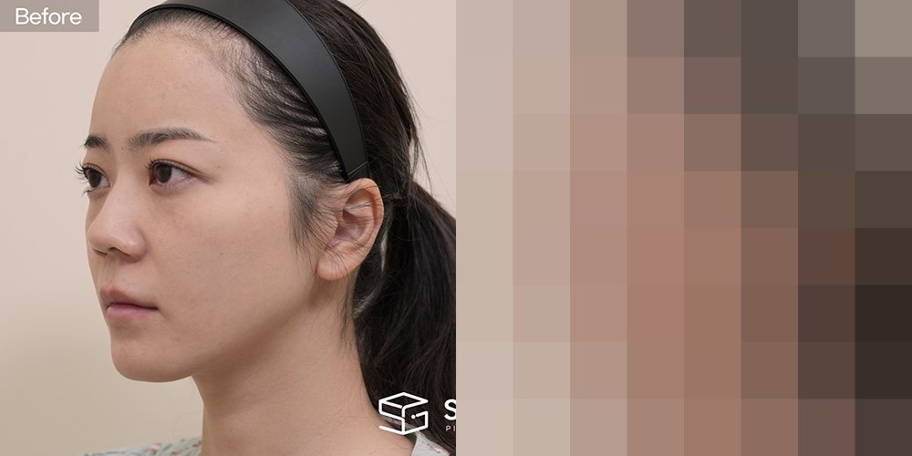 슈가성형외과 첫) 눈 밑 지방 재배치 + 이마거상 + 무보형물 + 자가늑 + 콧볼축소 + 복코 + 비주 연장 전후사진 - 45도 수술 전후 비교