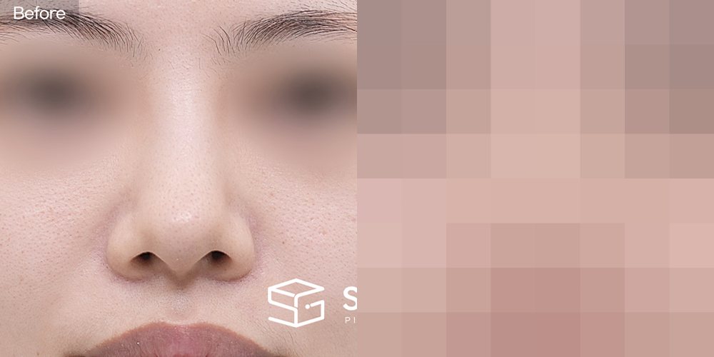 슈가성형외과 첫) 콧대 + 코끝 + 비중격 + 귀연골 + 기증늑 + 비주 연장 + 복코 전후사진 - 정면 수술 전후 비교