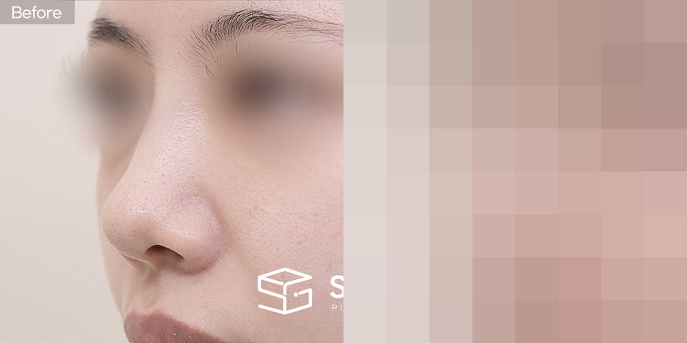 슈가성형외과 첫) 콧대 + 코끝 + 비중격 + 귀연골 + 기증늑 + 비주 연장 + 복코 전후사진 - 45도 수술 전후 비교
