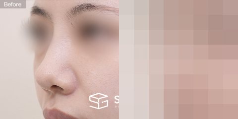 슈가성형외과 첫) 콧대 + 코끝 + 비중격 + 귀연골 + 기증늑 + 비주 연장 + 복코 전후사진 - 45도 수술 전후 비교