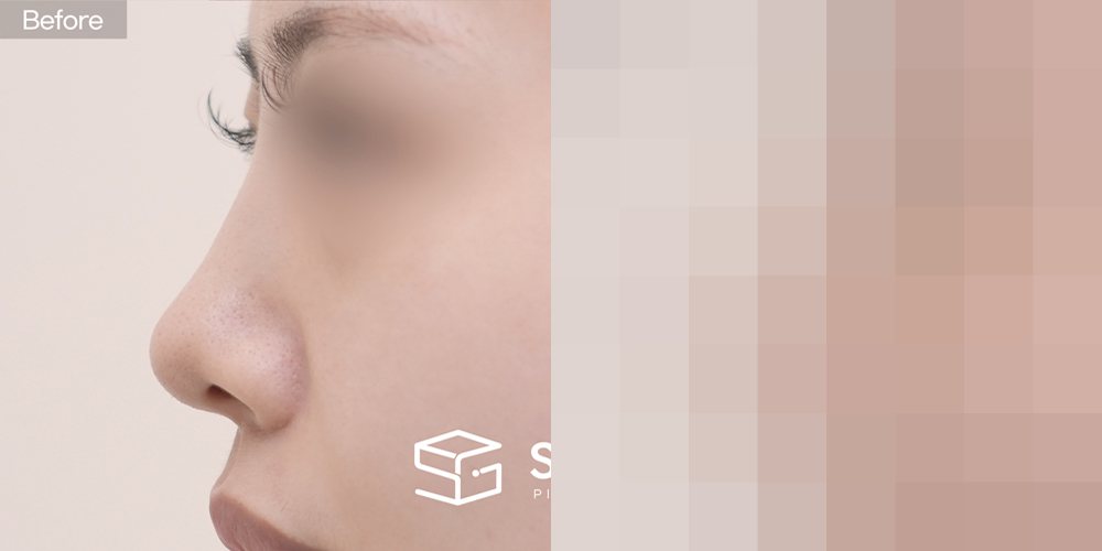 슈가성형외과 첫) 콧대 + 코끝 + 비중격 + 귀연골 + 기증늑 + 비주 연장 + 복코 전후사진 - 측면 수술 전후 비교
