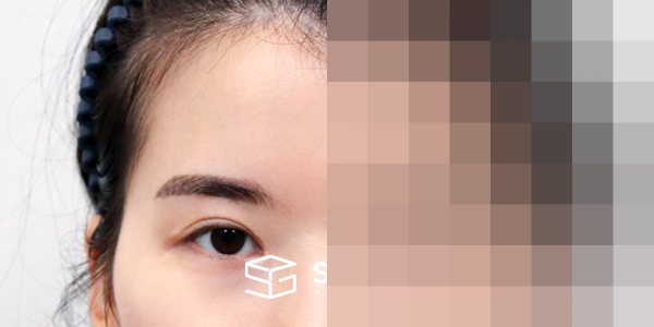 슈가성형외과 첫) 이마거상 + 뒷밑트임 전후사진 - 정면 수술 전후 비교
