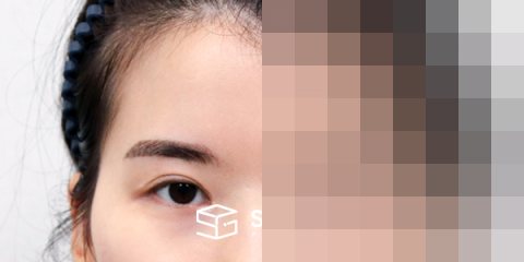 슈가성형외과 첫) 이마거상 + 뒷밑트임 전후사진 - 정면 수술 전후 비교
