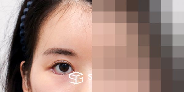 슈가성형외과 첫) 이마거상 + 뒷밑트임 전후사진 - 45도 수술 전후 비교