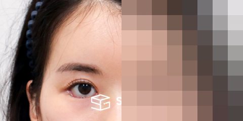 슈가성형외과 첫) 이마거상 + 뒷밑트임 전후사진 - 45도 수술 전후 비교