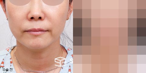 슈가성형외과 첫) 실리프팅 + 팔자주름 필러 전후사진 - 정면 수술 전후 비교
