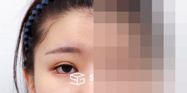 슈가성형외과 첫) 이마거상 + 앞트임 + 눈매교정 + 애교필러 전후사진 - 정면 수술 전후 비교