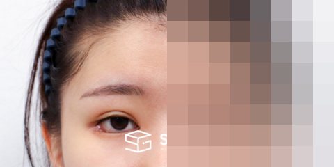 슈가성형외과 첫) 이마거상 + 앞트임 + 눈매교정 + 애교필러 전후사진 - 정면 수술 전후 비교