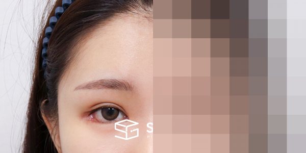 슈가성형외과 첫) 이마거상 + 앞트임 + 눈매교정 + 애교필러 전후사진 - 45도 수술 전후 비교