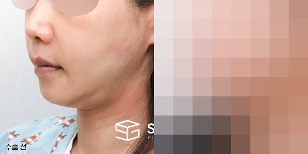 슈가성형외과 첫) 중안면부거상 + 이중턱 지방흡입 + 얼굴 지방이식 전후사진 - 정면 수술 전후 비교