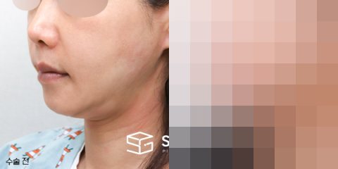 슈가성형외과 첫) 중안면부거상 + 이중턱 지방흡입 + 얼굴 지방이식 전후사진 - 정면 수술 전후 비교