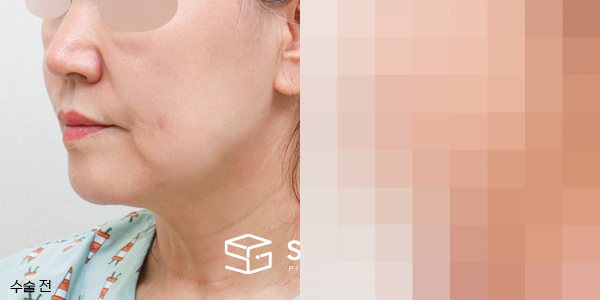 슈가성형외과 첫) 안면거상 + 심부볼 지방흡입 전후사진 - 45도 수술 전후 비교