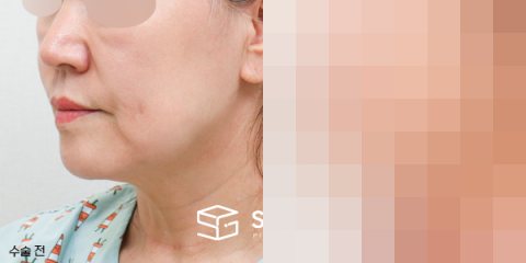 슈가성형외과 첫) 안면거상 + 심부볼 지방흡입 전후사진 - 45도 수술 전후 비교