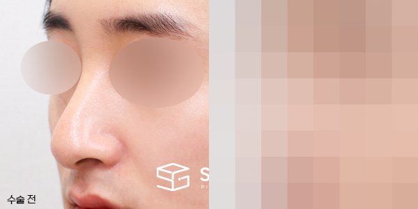 슈가성형외과 첫) 콧대코끝 + 매부리 + 휜코 + 절골 + 비중격 연장 전후사진 - 정면 수술 전후 비교