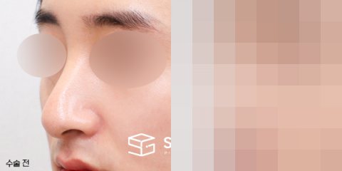 슈가성형외과 첫) 콧대코끝 + 매부리 + 휜코 + 절골 + 비중격 연장 전후사진 - 정면 수술 전후 비교