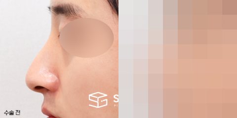 슈가성형외과 첫) 콧대코끝 + 매부리 + 휜코 + 절골 + 비중격 연장 전후사진 - 45도 수술 전후 비교