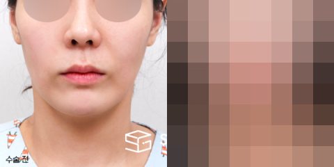 슈가성형외과 첫) 얼굴 지방이식 + 입술필러 전후사진 - 정면 수술 전후 비교