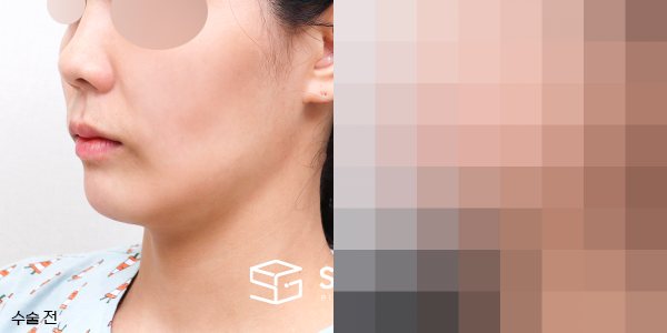 슈가성형외과 첫) 얼굴 지방이식 + 입술필러 전후사진 - 45도 수술 전후 비교