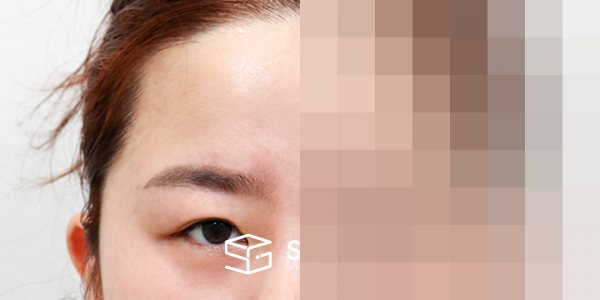 슈가성형외과 첫) 이마거상 + 뒷밑트임 전후사진 - 정면 수술 전후 비교