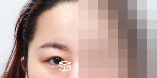 슈가성형외과 첫) 이마거상 + 뒷밑트임 전후사진 - 45도 수술 전후 비교