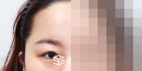 슈가성형외과 첫) 이마거상 + 뒷밑트임 전후사진 - 45도 수술 전후 비교
