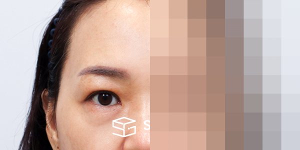 슈가성형외과 첫) 이마거상 + 하안검 + 중안면부거상 전후사진 - 정면 수술 전후 비교