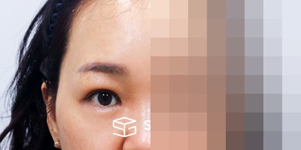슈가성형외과 첫) 이마거상 + 하안검 + 중안면부거상 전후사진 - 45도 수술 전후 비교